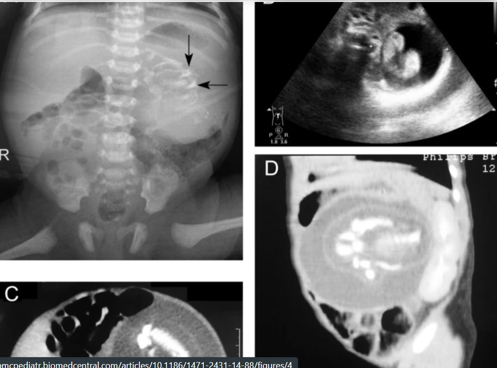 fetusinfetu, hamil, bayilaki-laki, sumaterabarat, limabulan, parasit, tumor, kanker, embriogenesis, teratoma, bayikembar, selgerminal