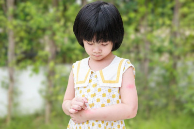 6 PENYEBAB IMPETIGO BULOSA YANG MENYERANG KULIT ANAK 