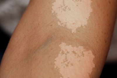 LANGSUNG CUCI WAJAH SETELAH TERPAPAR SINAR UV BIKIN PANUAN, MITOS ATAU FAKTA?
