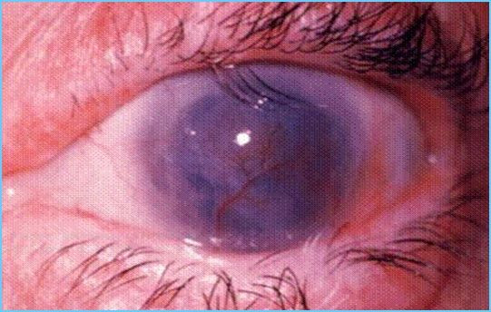 trakoma adalah, trakoma disebabkan oleh, trakoma disebabkan oleh virus atau bakteri, trakoma mata, trachoma, trakoma disebabkan, yesdok