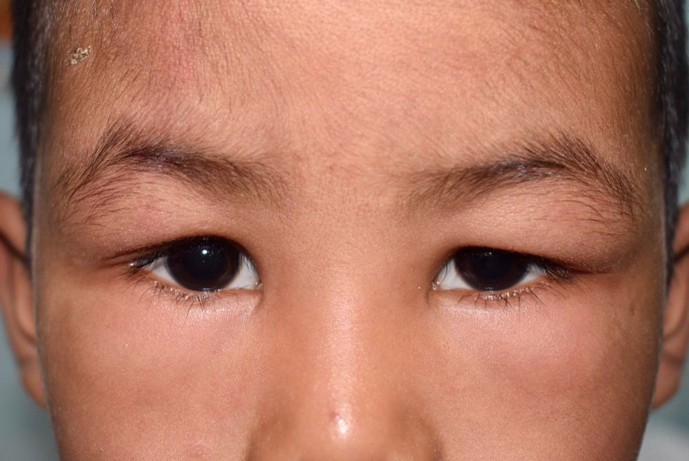 Angioedema, angioedema adalah, apa itu angioedema, penyebab angioedema, kode icd 10 angioedema, angioedema bibir, angioedema herediter, angioedema treatment, yesdok