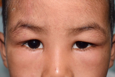 Angioedema Dapat Muncul Karena 6 Penyebab Ini