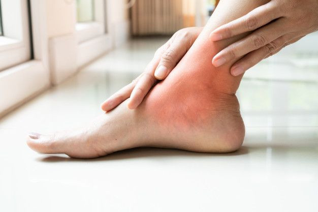 Psoriasis arthritis.