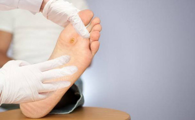 Tips Perawatan Luka pada Pasien Diabetes