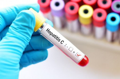 Penyebab Hepatitis C yang Perlu Diketahui