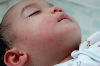 Pandemi COVID 19 Berpotensi Membuat Kasus Campak pada Anak Meningkat