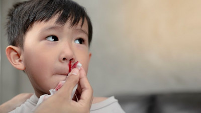 Jangan Panik, Ini Cara Mengatasi Mimisan pada Anak