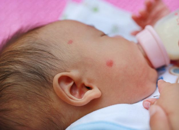 Bayi yang mengalami bentol akibat gigitan nyamuk