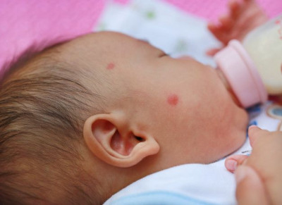 6 Cara Alami Atasi Bentol Pada Bayi