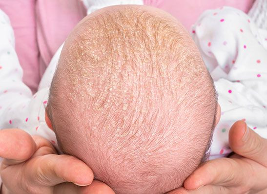 Cradle Cap, Kerak Kepala Bayi dan Cara Membersihkannya