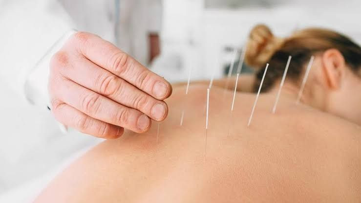 Terapi Akupunktur