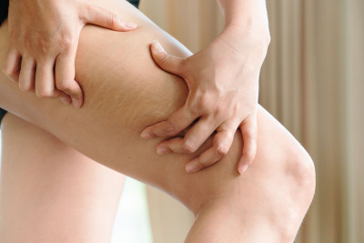 Pemicu Stretch Mark dan Cara Mengatasinya