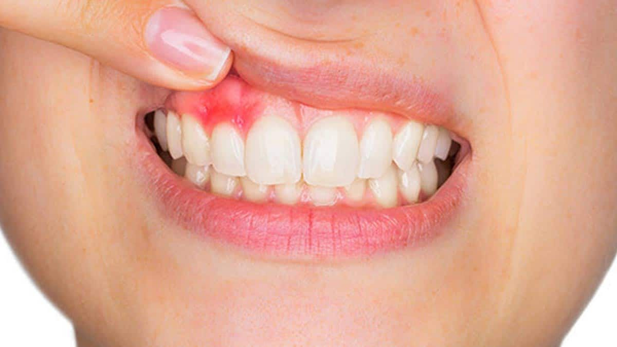 Gingivitis