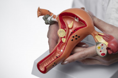 Awas, Mitos Endometriosis Ini Jangan Dipercaya!