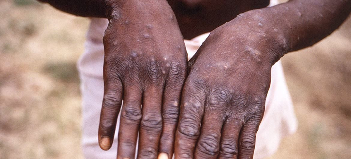 gejala monkeypox