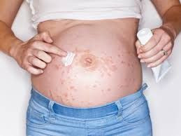 herpes kehamilan
