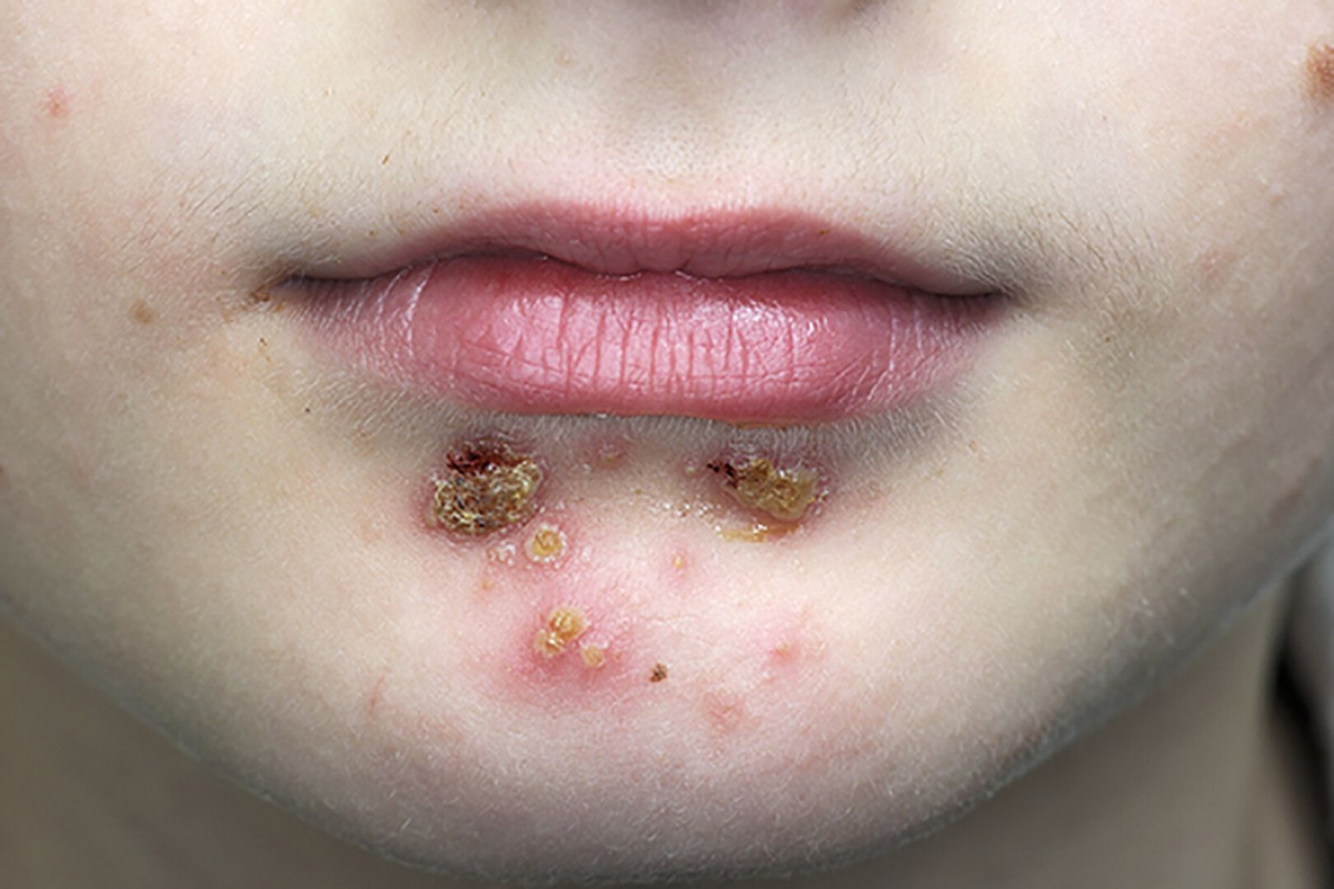 Infeksi Kulit Impetigo