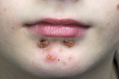 Ini yang Perlu Diketahui dari Infeksi Kulit Impetigo