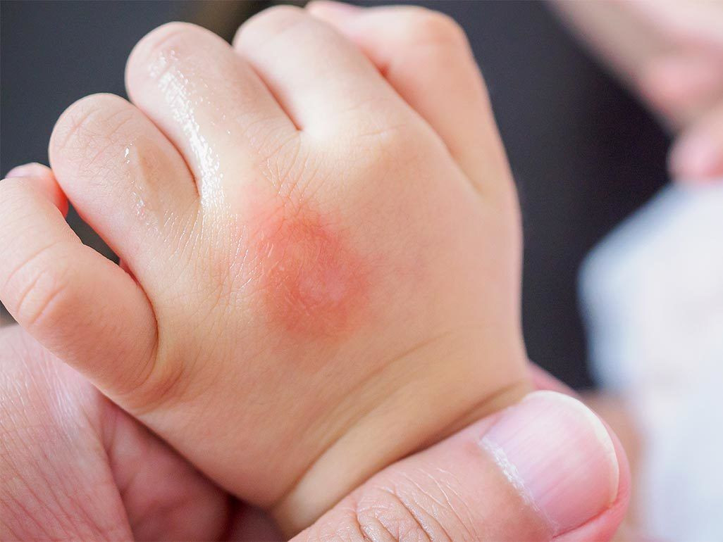 Menular, Begini Cara Mencegah Kudis Pada Anak