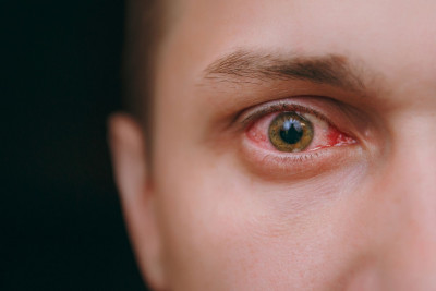 Awas, Konjungtivitis Menjadi Salah Satu Gejala Covid-19