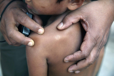 Kenali Penyebab, Gejala, dan Faktor Risiko Penyakit Kusta