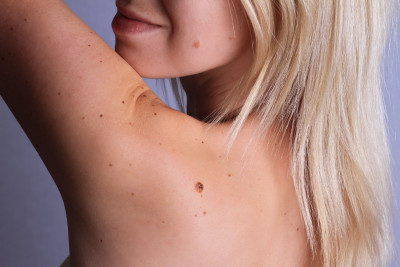 Kenali Beberapa Gejala Melanoma