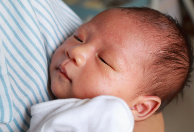 Mengenal Masalah Kulit Milia pada Bayi