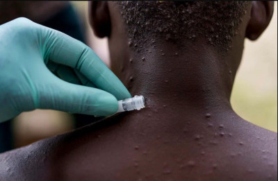 Seorang Pria Dilarikan ke Rumah Sakit Setelah Terpapar Monkeypox