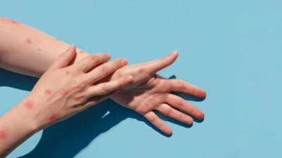 Fakta-fakta Mengenai Temuan Kasus Monkeypox Pertama di Indonesia