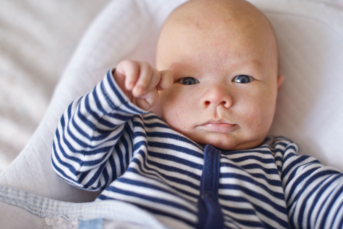 Kulit kering pada bayi.