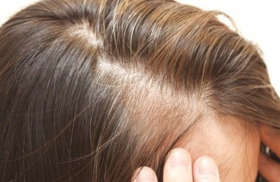 Dapatkah Diabetes Memengaruhi Kesuburan Rambut?