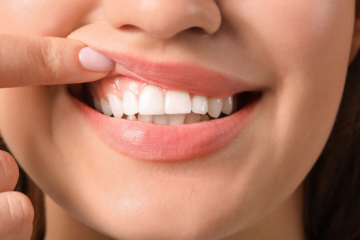 Apa Itu Periodontitis? Saat Radang Gusi Menjadi Lebih Parah | Yesdok.com