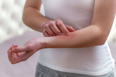 Perubahan Gaya Hidup Bagi Penderita Psoriasis