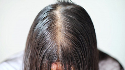 Penyebab Rambut Menipis dan Pengobatan Rumahannya