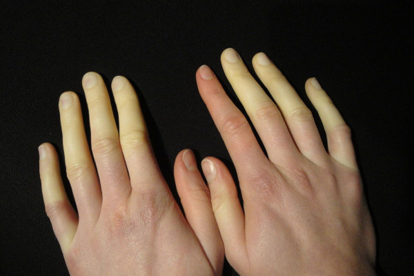 gejala fenomena raynaud