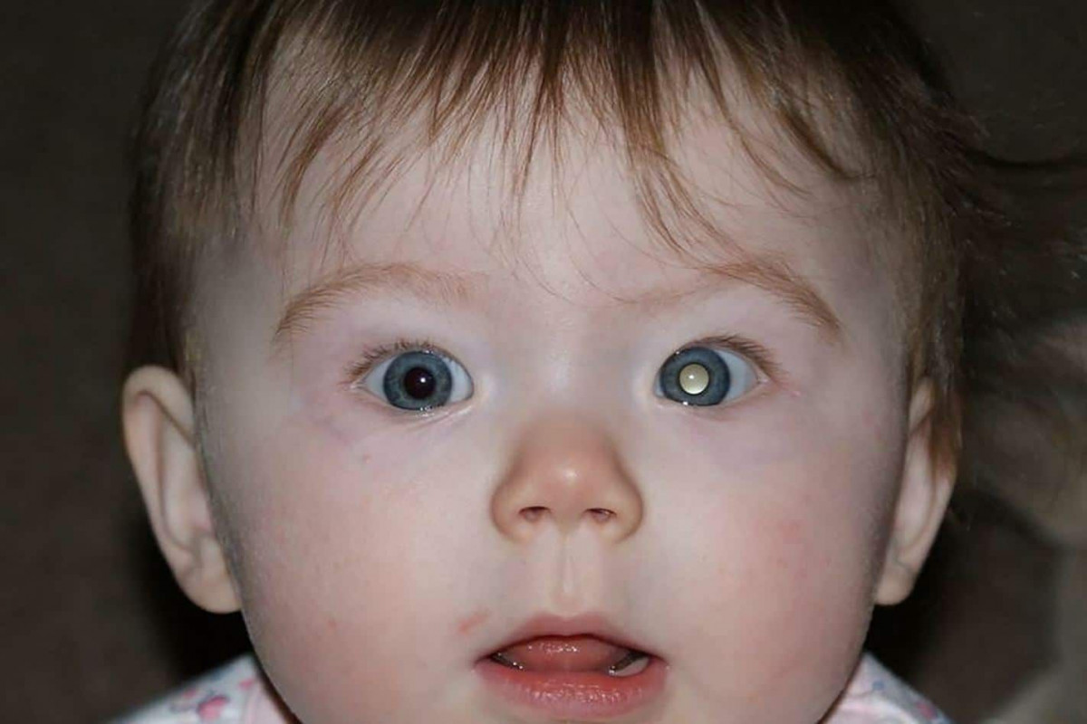 Retinoblastoma Adalah