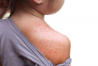 Apa Itu Roseola? Kenali Penyakit Penyebab Demam Tinggi dan Ruam pada Anak