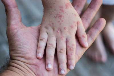 Monkeypox dapat Ditularkan dari Hewan ke Manusia
