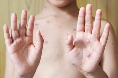 Berbagai Cara Penularan Monkeypox Menurut Penjelasan WHO