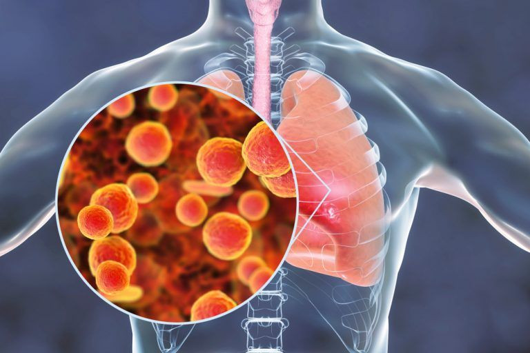 Infeksi Pneumonia Mycoplasma