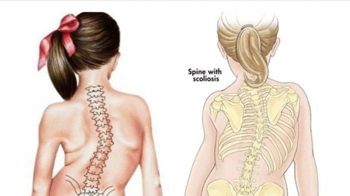 7 Penyebab Skoliosis yang Perlu Diwaspadai
