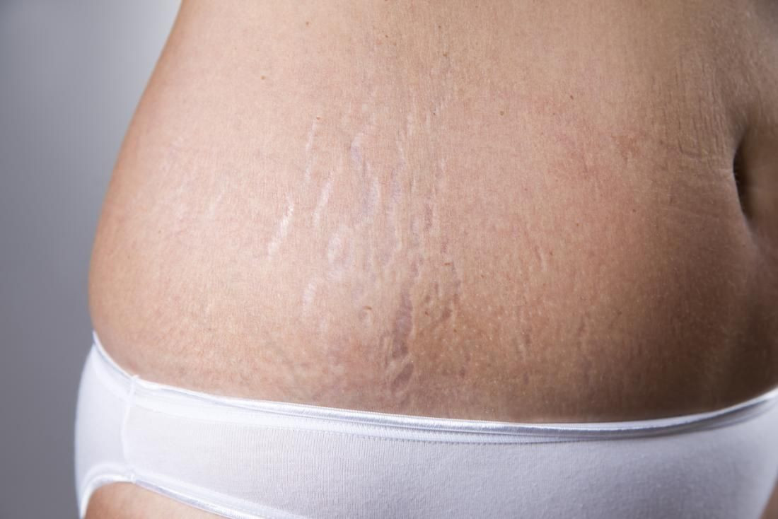 Sering Keliru, Ini Perbedaan Selulit dan Stretch Mark