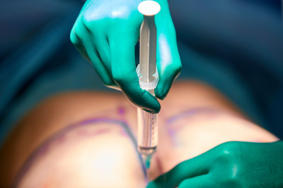 Mengenal Liposuction atau Sedot Lemak 