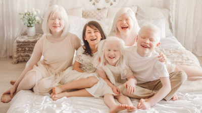 Penyebab Anak Terlahir Albino
