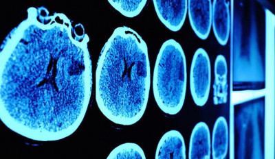 Kecerdasan Buatan Bantu Deteksi Tumor dengan Lebih Cepat