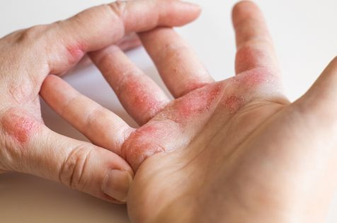 Mengenal Penyakit Kusta, Gejala, Penyebab dan Cara Mengobatinya | YesDok