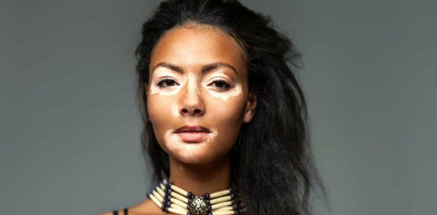 Mengenal Vitiligo, Gangguan yang Terjadi pada Kulit