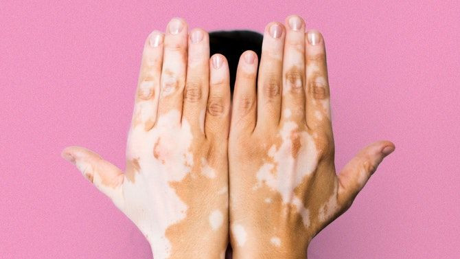 apakah vitiligo menular