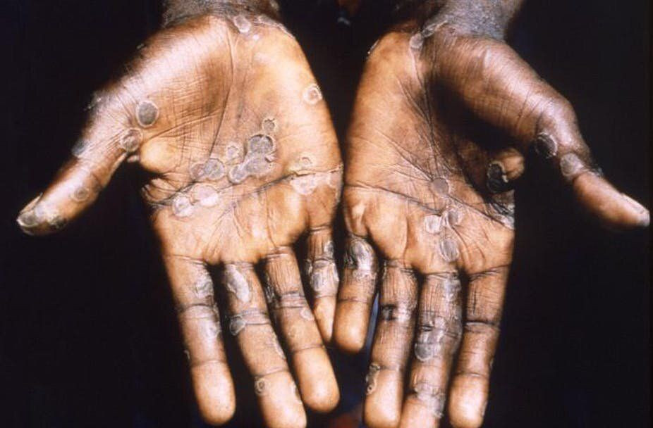 monkeypox