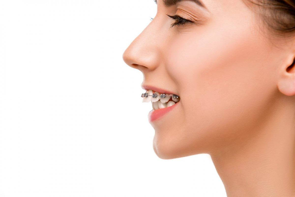 Mengenal Gigi Overbite Penyebab Dan Cara Mengatasinya YesDok mengenal-gigi-overbite-penyebab-dan-cara-mengatasinya-yesdok